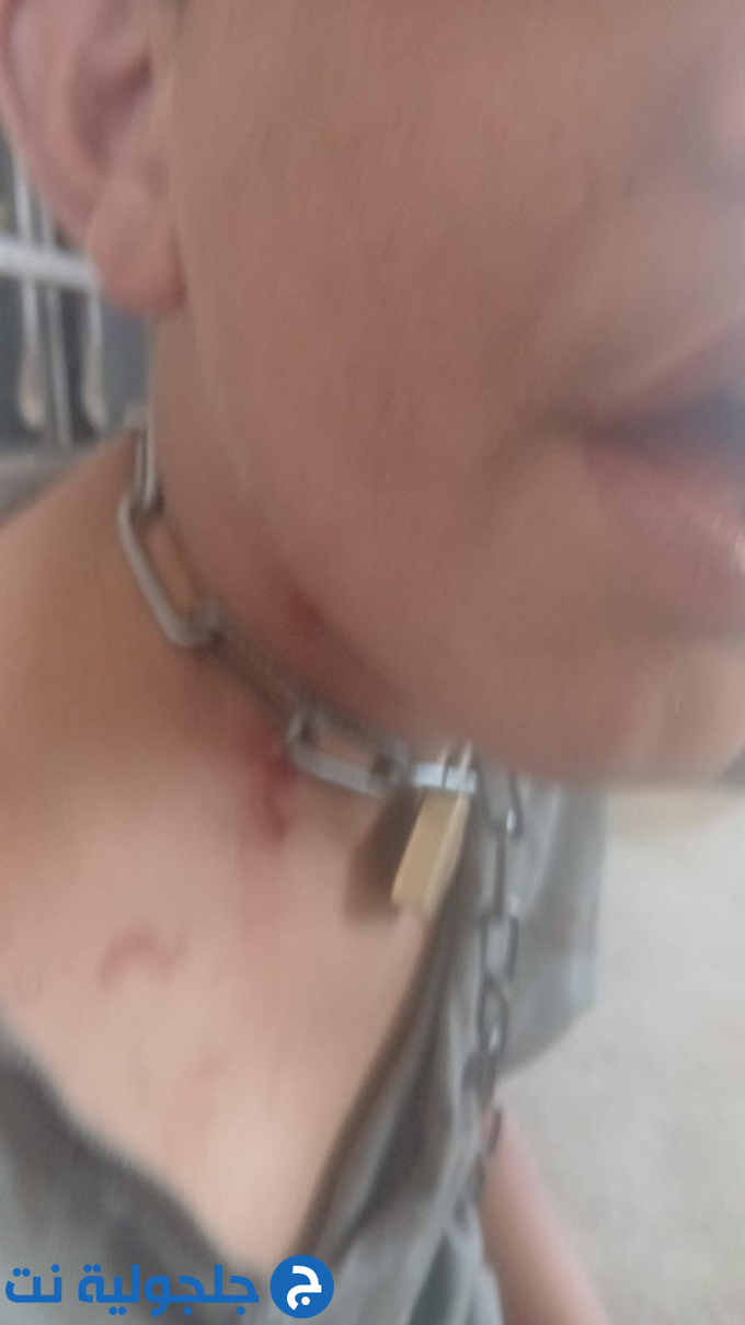 ضرب وتعذيب فتى من ذوي الاحتياجات الخاصة من قبل اقاربه في يطا